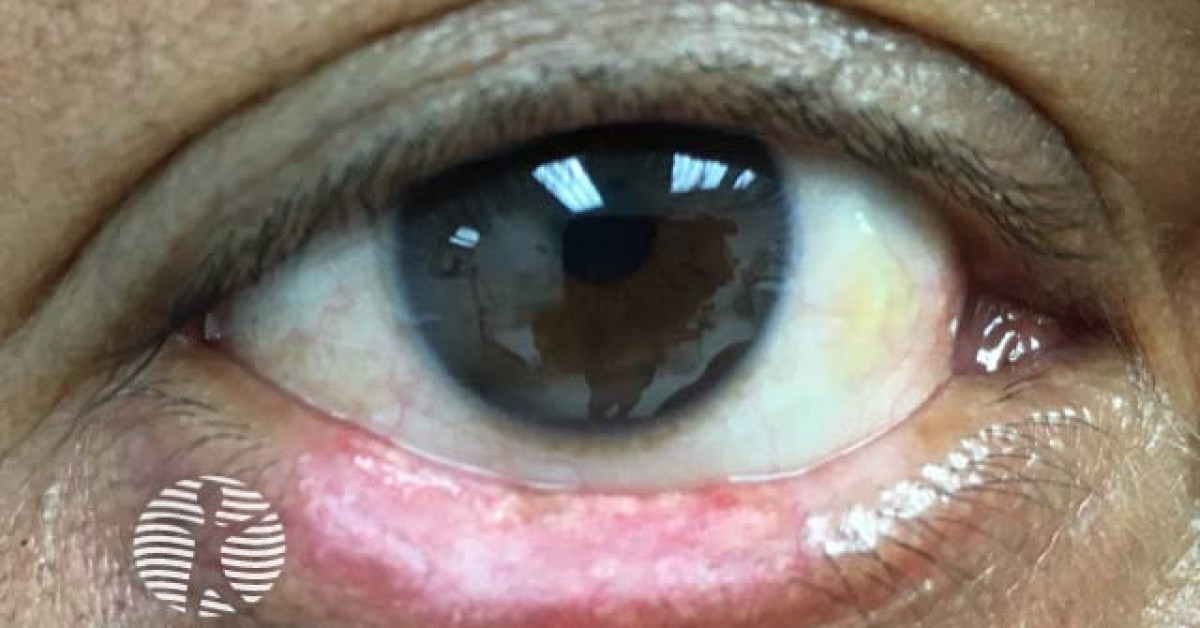 DermNet® - Madarosis due to discoid lupus erythematosus image