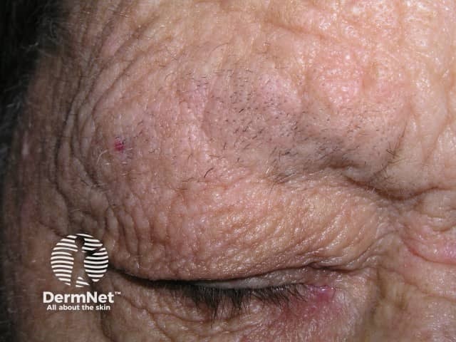 Madarosis due to rubbing of eyebrows