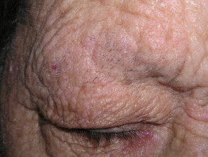 Madarosis due to atopic dermatitis