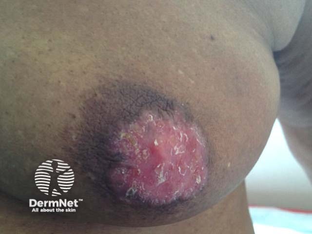 Mammary Paget disease of the skin in a female