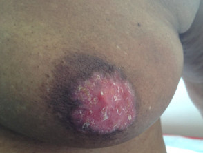 Mammary Paget disease of the skin