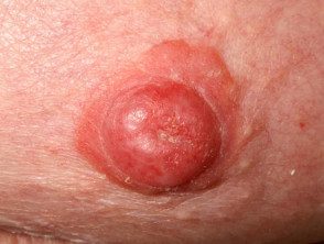 Mammary Paget disease of the skin