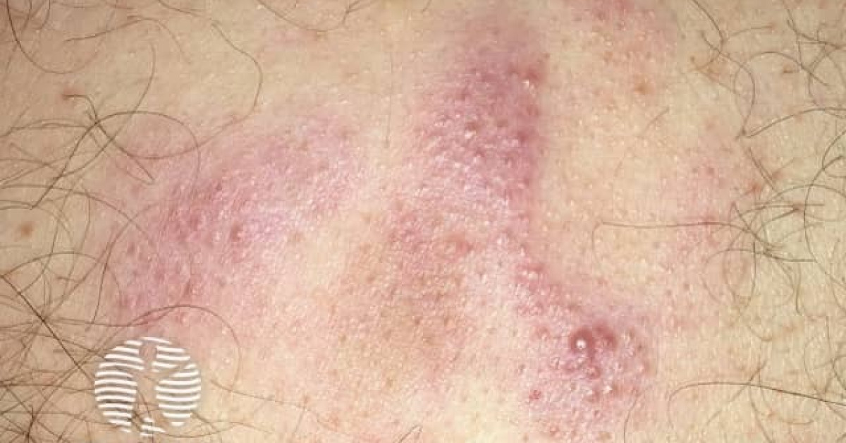 Cutaneous marginal zone lymphoma image