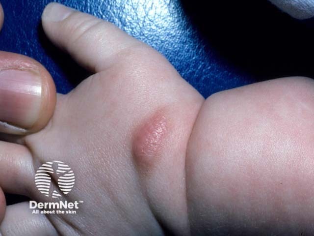 Solitary mastocytoma on a toddler’s hand
