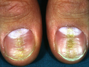 Median canaliform nail dystrophy