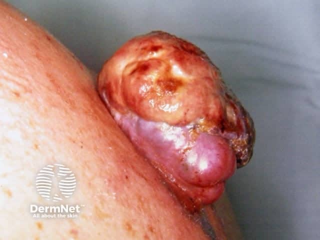 Ulcerated nodular melanoma