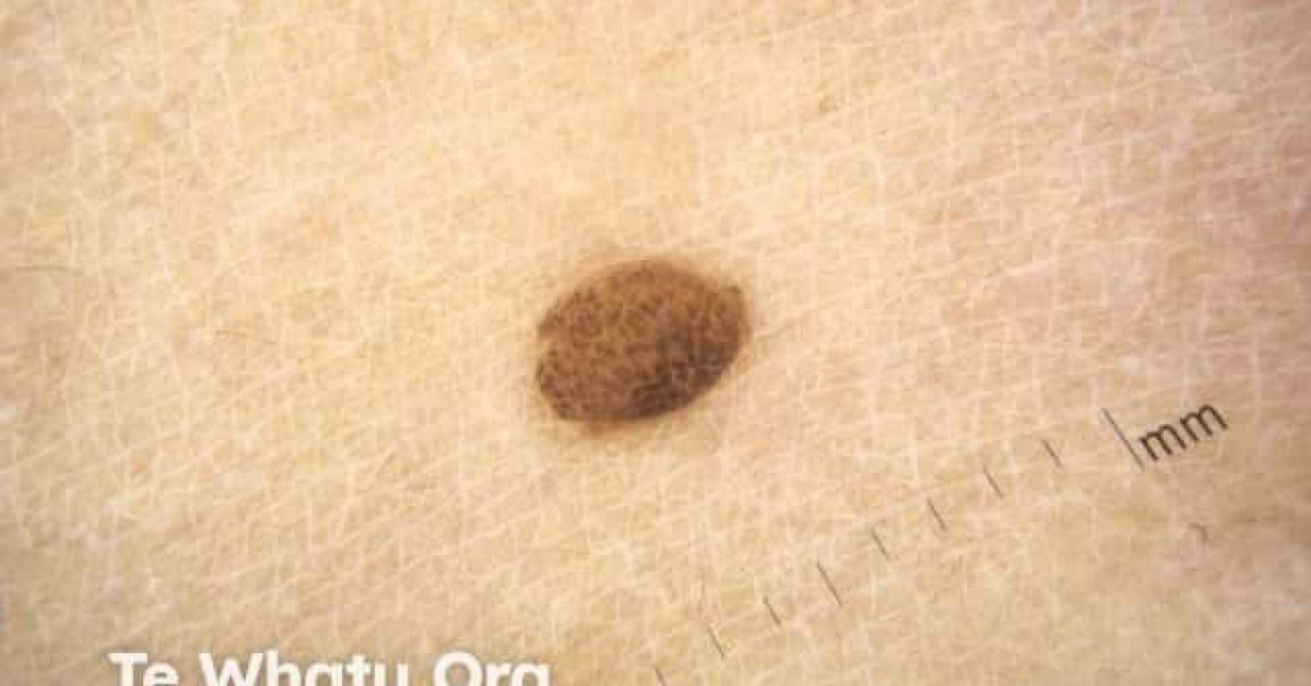 melanocytic-naevus-image