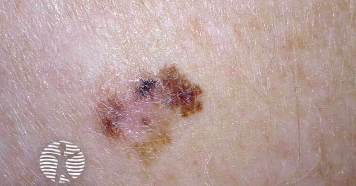 Superficial spreading melanoma image