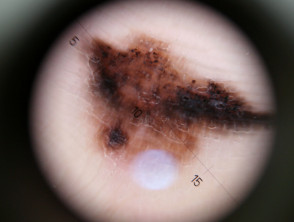 Acral lentiginous melanoma dermoscopy