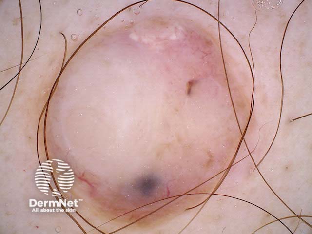 Nodular melanoma, Breslow 7.2 mm, nonpolarised dermoscopy view