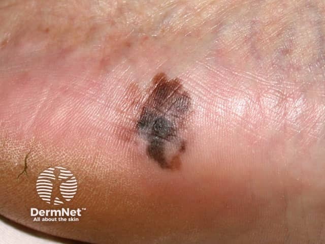 Slowly enlarging, irregularly pigmented, and marginated lesion showing central hypopigmentation and regression - an acral lentiginous melanoma