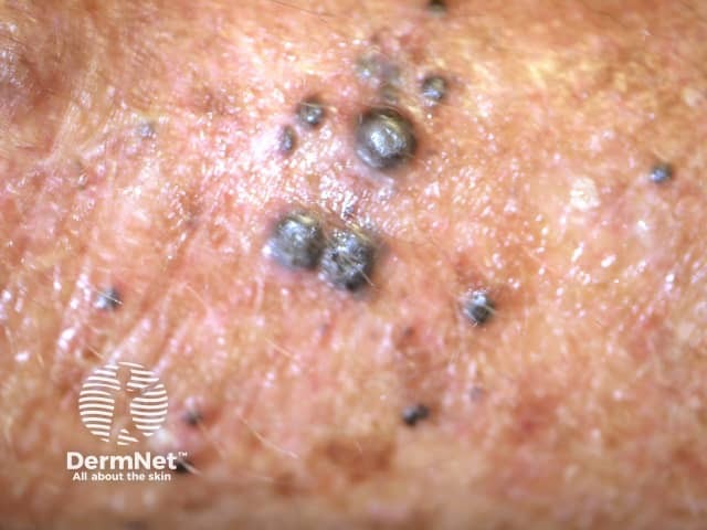 Multiple cutaneous metastasis from a melanoma, a potential candidate for talimogene