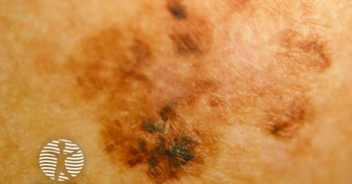 DermNet® - Melanoma in situ image