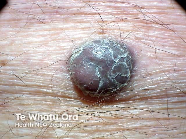 Nodular malignant melanoma in a vertical growth phase - rapidly enlarging scaly pigmented nodule