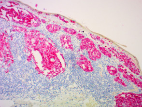 Melanoma pathology stained with Melan A x100