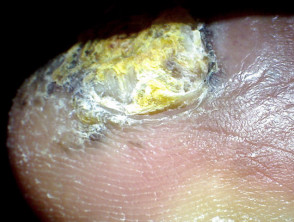 Subungual melanoma of the toenail