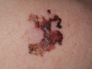 Large superficial spreading melanoma