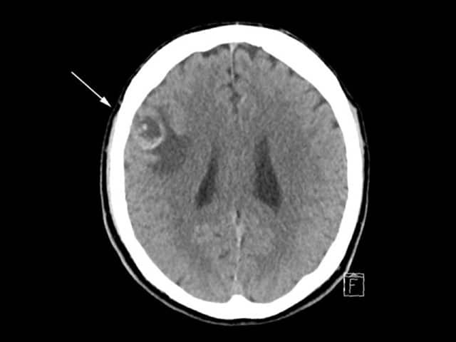 CT scan of brain with melanoma metastasis