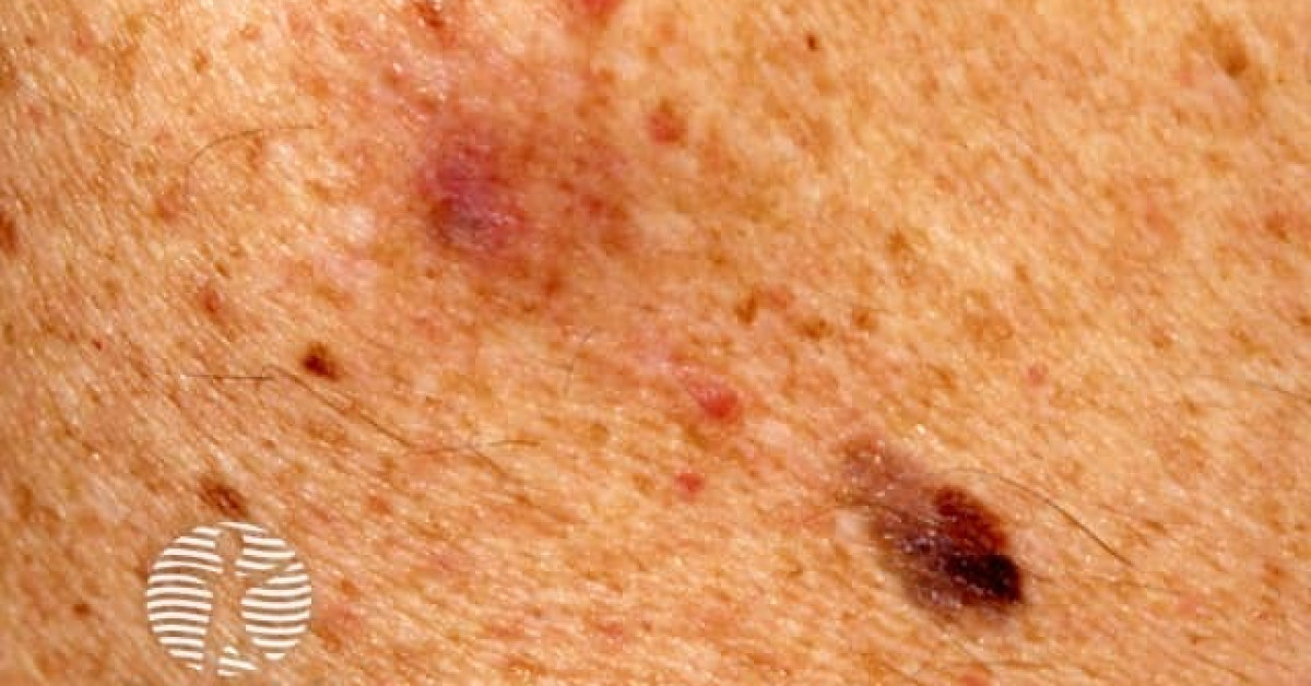 Desmoplastic melanoma image