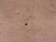 Early melanoma