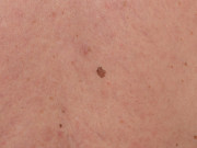 Early melanoma