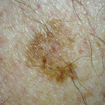 Melanoma changes over time