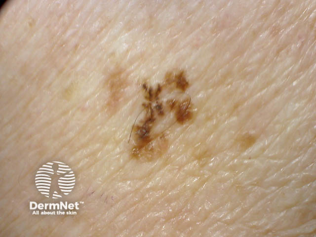 Close-up of melanoma*