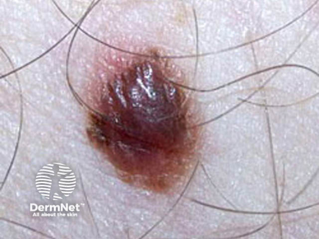 Close-up of melanoma**