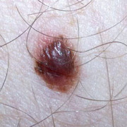 Malignant melanoma in man with many and unusual moles