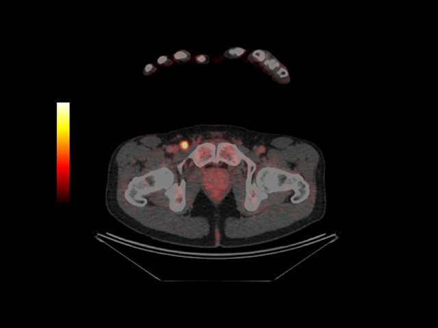 PET-CT scan: metastasis glows in groin