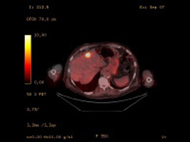 Fused PET/CT image of liver metastasis