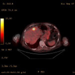 Fused PET/CT image of liver metastasis