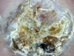 Dermoscopy of a 6 mm thick nodular melanoma