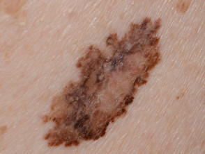 0.4 mm thick superficial spreading melanoma