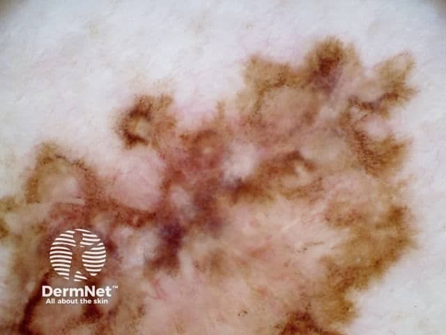 Dermoscopic image of superficial spreading melanoma 4 (top half of lesion)