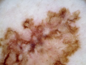 0.4 mm thick superficial spreading melanoma dermoscopy