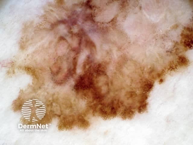 Dermoscopic image of superficial spreading melanoma 4 (bottom half of lesion)