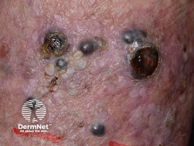 Secondary melanoma in the skin