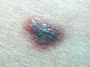 Spitzoid melanoma