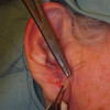 Suturing surgical wound after removal of melanoma