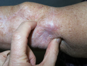 Cutaneous melanoma mestastases