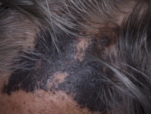 Cutaneous melanoma mestastases