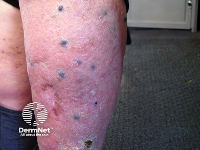 Metastatic Melanoma Image