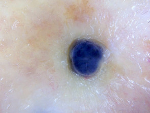 metastatic melanoma