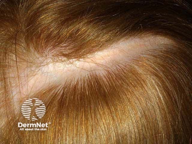 Linear cicatricial alopecia in morphoea en coup de sabre