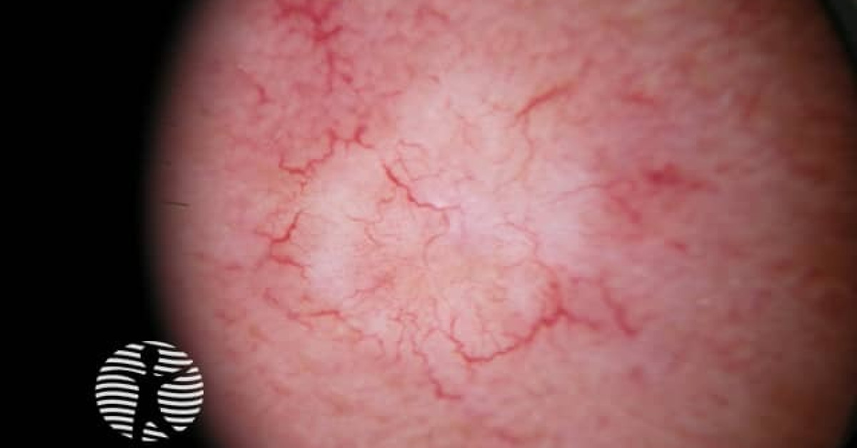Morphoeic basal cell carcinoma dermoscopy image