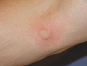 Mosquito bite 