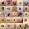 Many melanomas