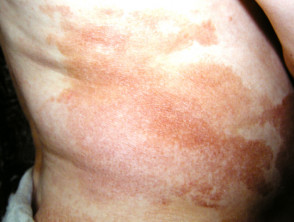 Patch stage mycosis fungoides