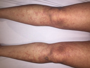 Folliculocentric mycosis fungoides